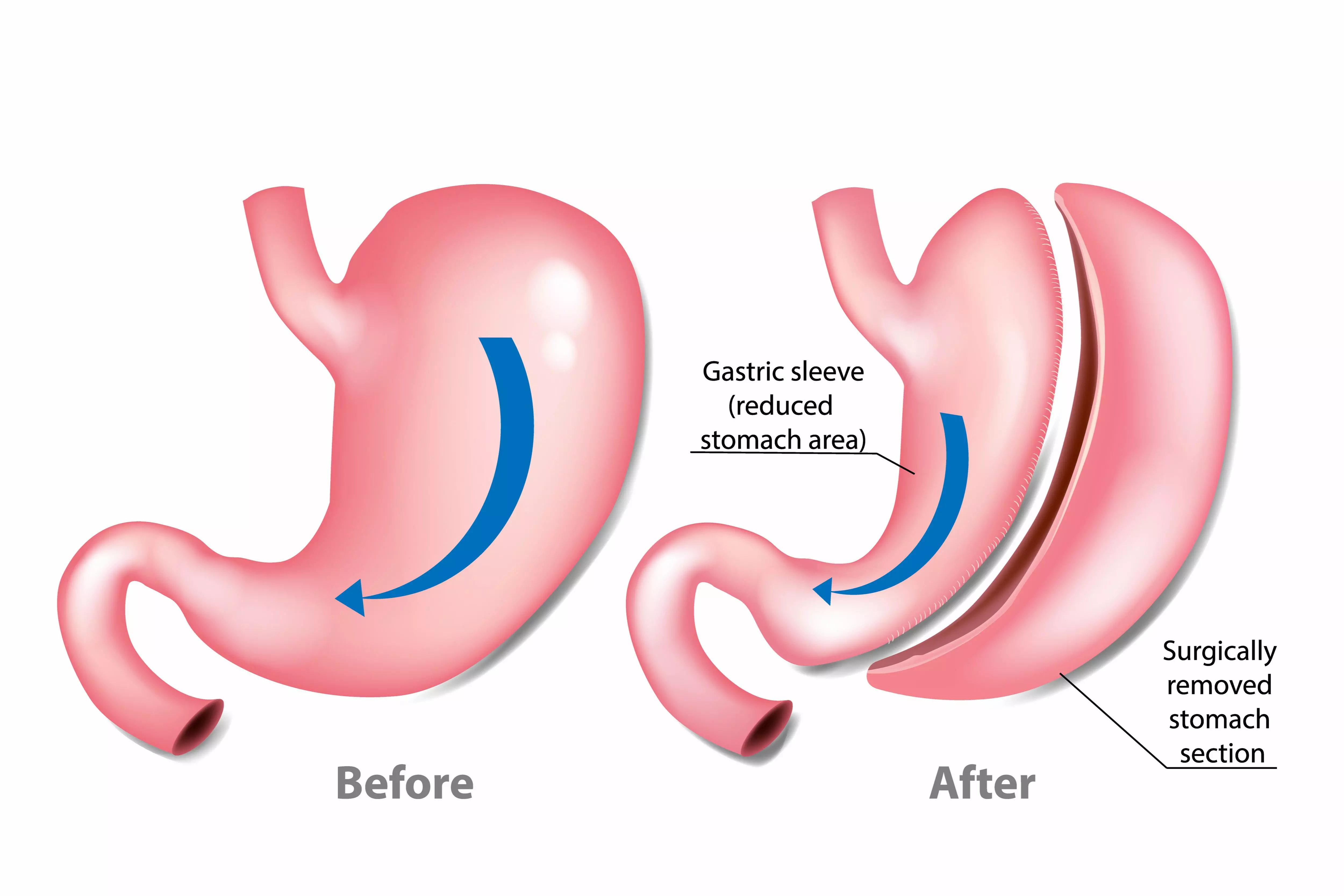 Gastrectomy