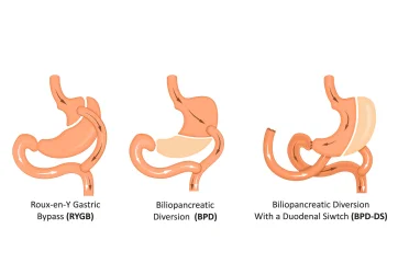 Gastrectomy